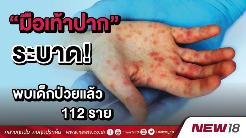 "มือเท้าปาก" ระบาด! พบเด็กป่วยแล้ว 112 ราย 