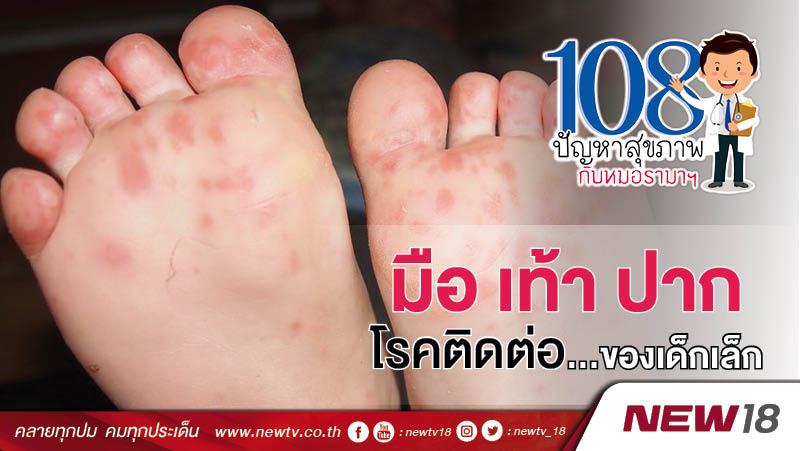 108 ปัญหากับหมอรามาฯ : มือ เท้า ปาก โรคติดต่อของเด็กเล็ก