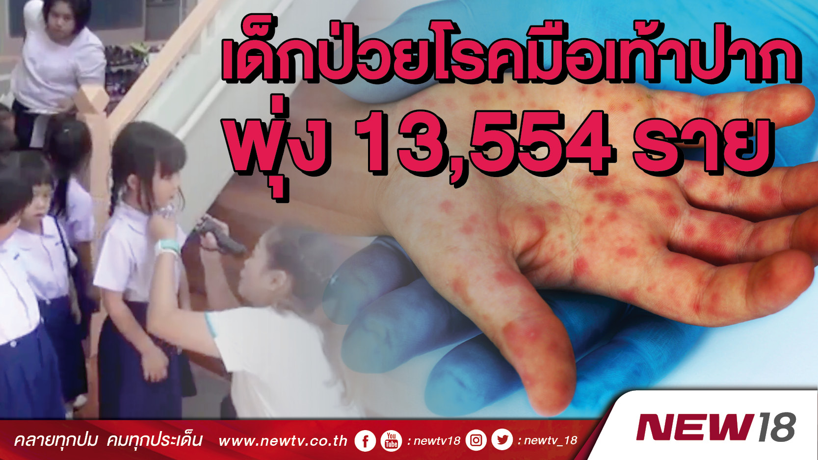 เด็กป่วยโรคมือเท้าปากพุ่ง 13,554 ราย 