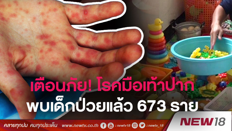 เตือนภัย! โรคมือเท้าปาก พบเด็กป่วยแล้ว 673 ราย