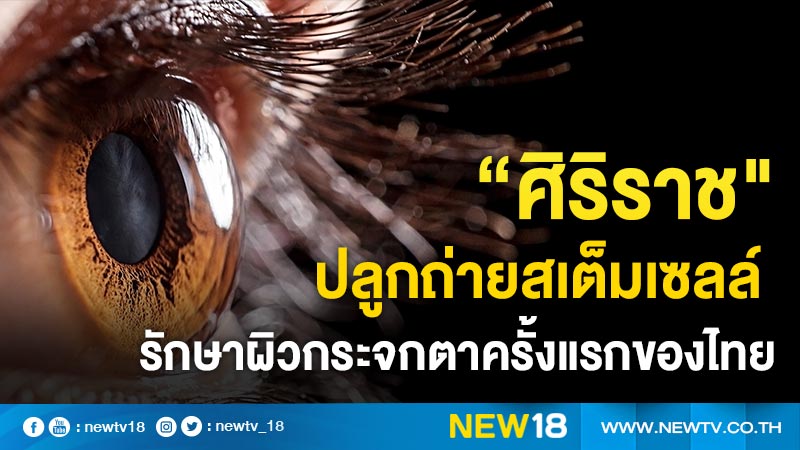 “ศิริราช" ปลูกถ่ายสเต็มเซลล์รักษาผิวกระจกตาครั้งแรกของไทย