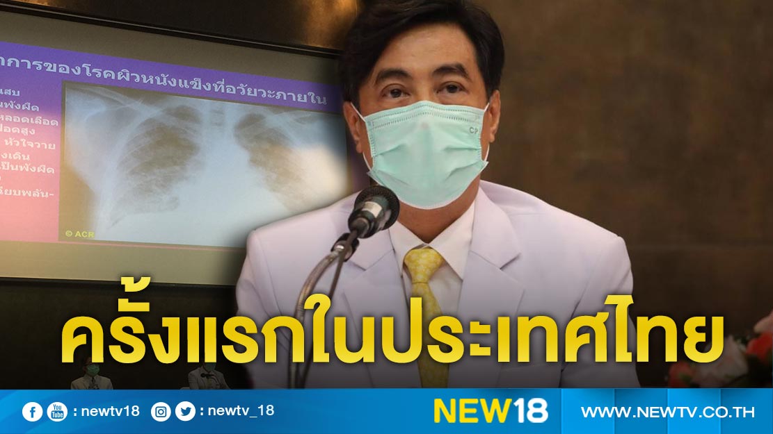 จุฬาฯปลูกถ่ายสเต็มเซลล์รักษาผู้ป่วยโรคผิวหนังแข็งสำเร็จครั้งแรกในประเทศไทย