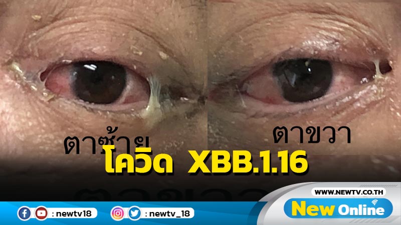 "หมอมนูญ"เผยชายไทยติดโควิด  XBB.1.16 ตาแดง ขี้ตาเหนียว